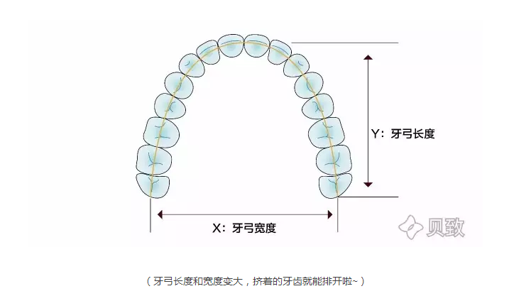 (牙弓长度和宽度变大,挤着的牙齿就能排开啦~)